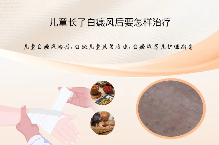 儿童长了白癜风后要怎样治疗