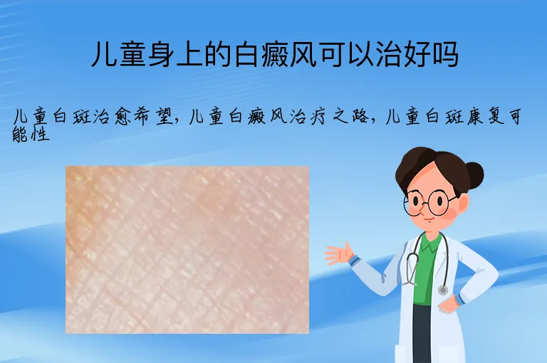 儿童身上的白癜风可以治好吗