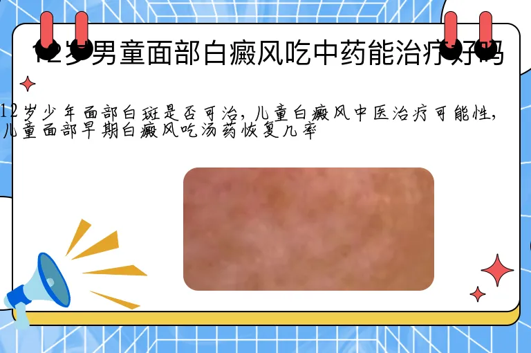 12岁男童面部白癜风吃中药能治疗好吗