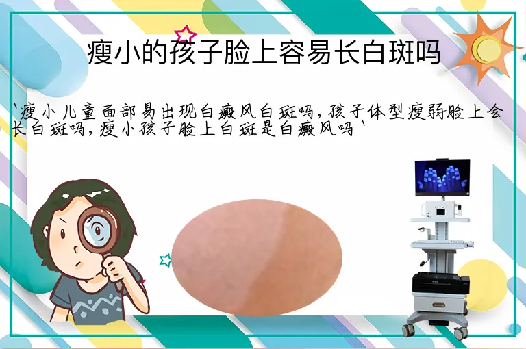 瘦小的孩子脸上容易长白斑吗