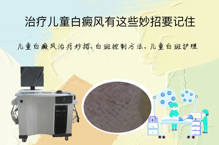 治疗儿童白癜风有这些妙招要记住