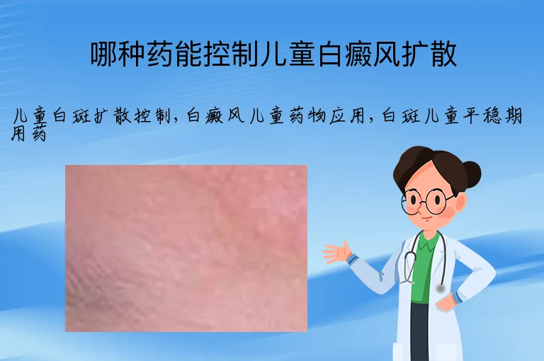 哪种药能控制儿童白癜风扩散