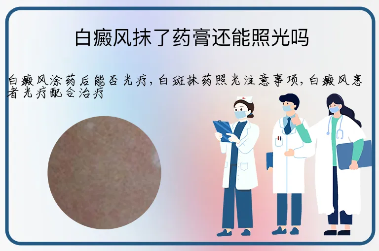 白癜风抹了药膏还能照光吗