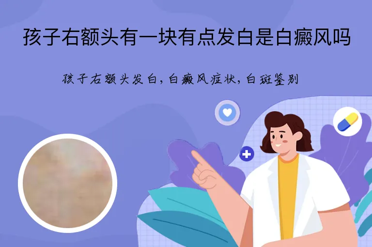 孩子右额头有一块有点发白是白癜风吗
