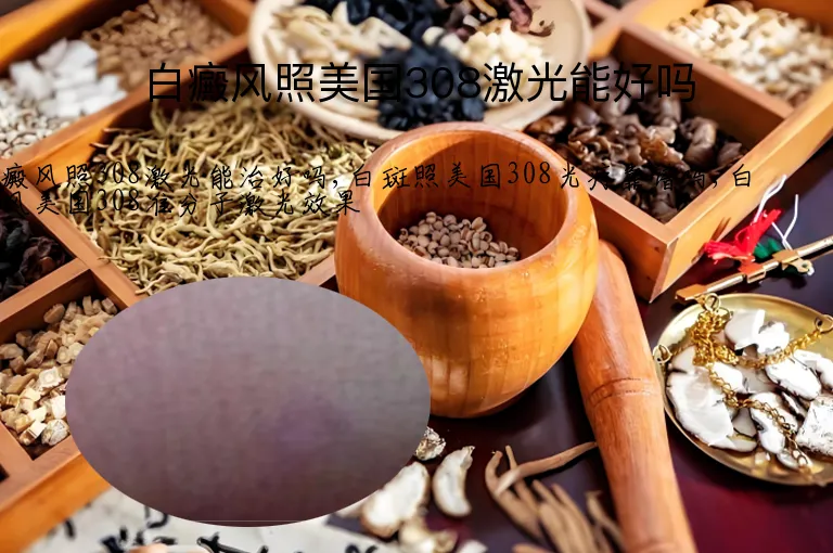 白癜风照美国308激光能好吗