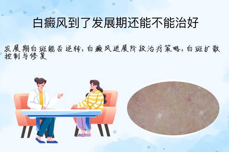 白癜风到了发展期还能不能治好