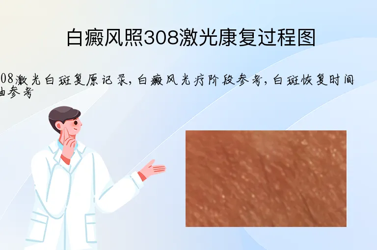 白癜风照308激光康复过程图