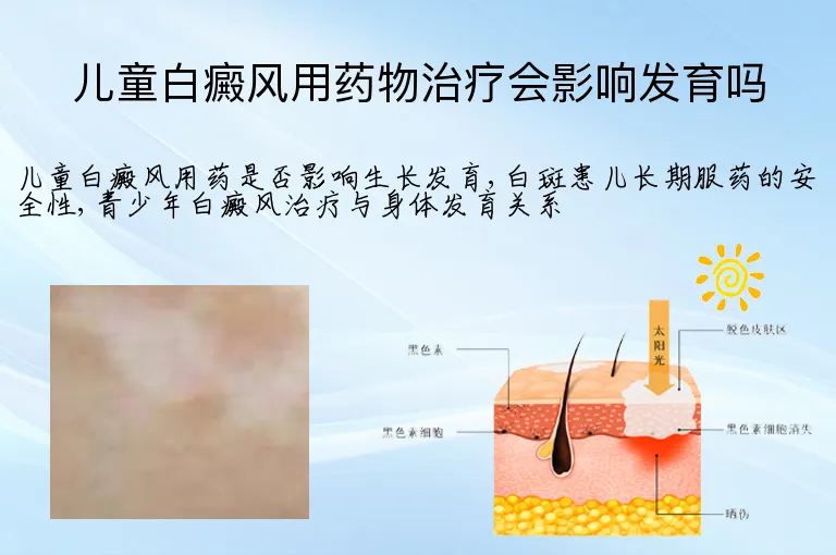 儿童白癜风用药物治疗会影响发育吗