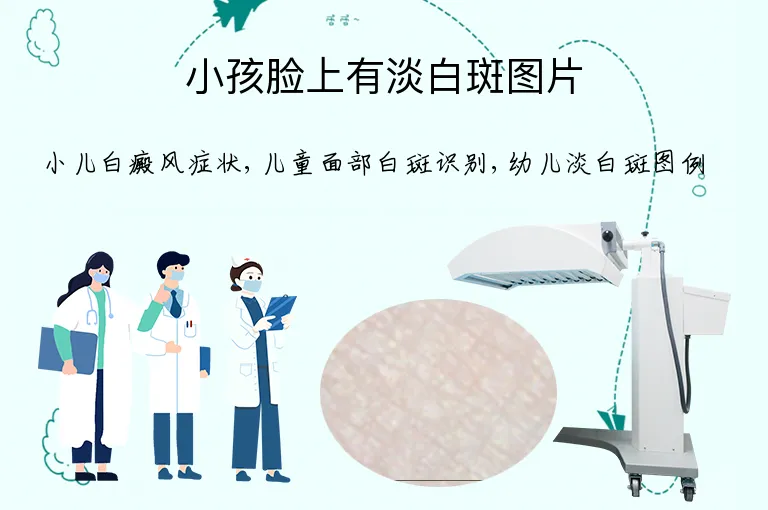 小孩脸上有淡白斑图片