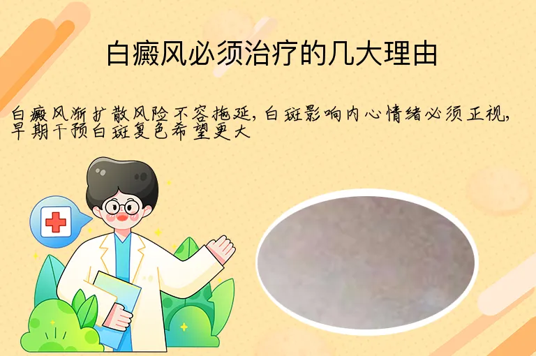 白癜风必须治疗的几大理由