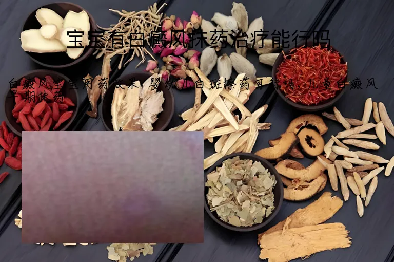 宝宝有白癜风抹药治疗能行吗