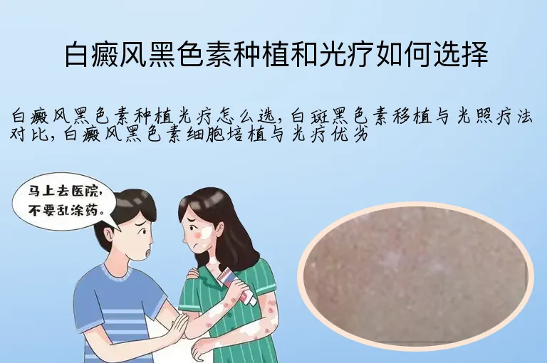 白癜风黑色素种植和光疗如何选择