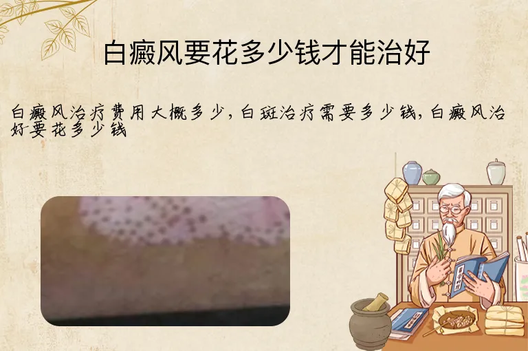 白癜风要花多少钱才能治好