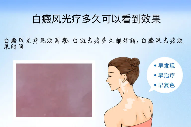 白癜风光疗多久可以看到效果
