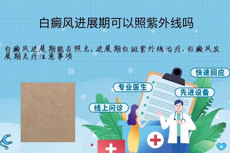 白癜风进展期可以照紫外线吗