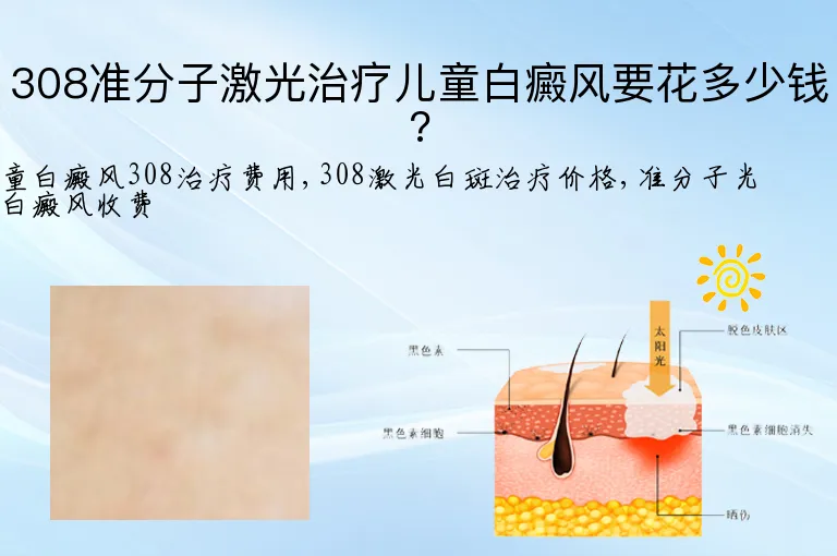 308准分子激光治疗儿童白癜风要花多少钱?