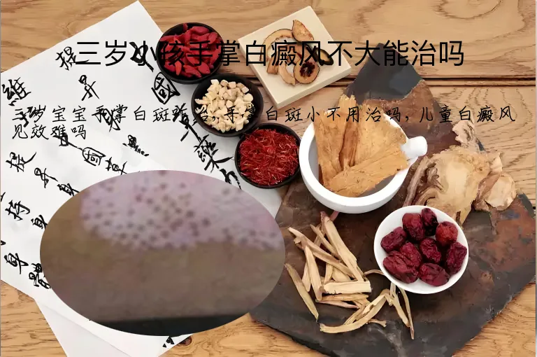 三岁小孩手掌白癜风不大能治吗