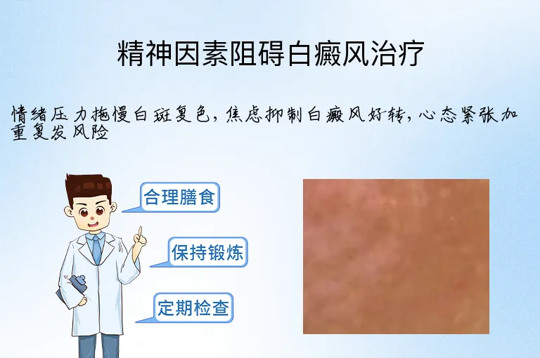 精神因素阻碍白癜风治疗