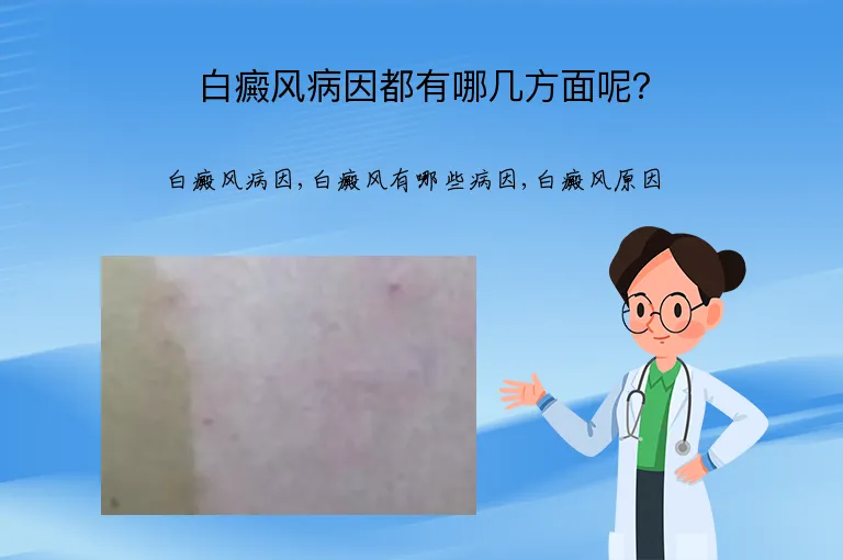 白癜风病因都有哪几方面呢？
