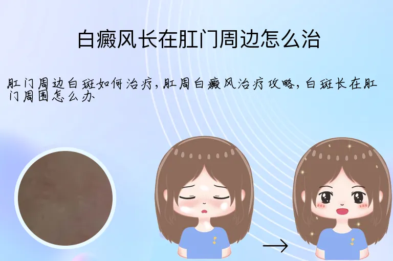 白癜风长在肛门周边怎么治
