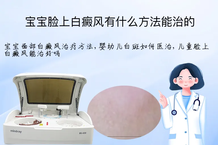 宝宝脸上白癜风有什么方法能治的