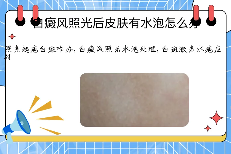 白癜风照光后皮肤有水泡怎么办