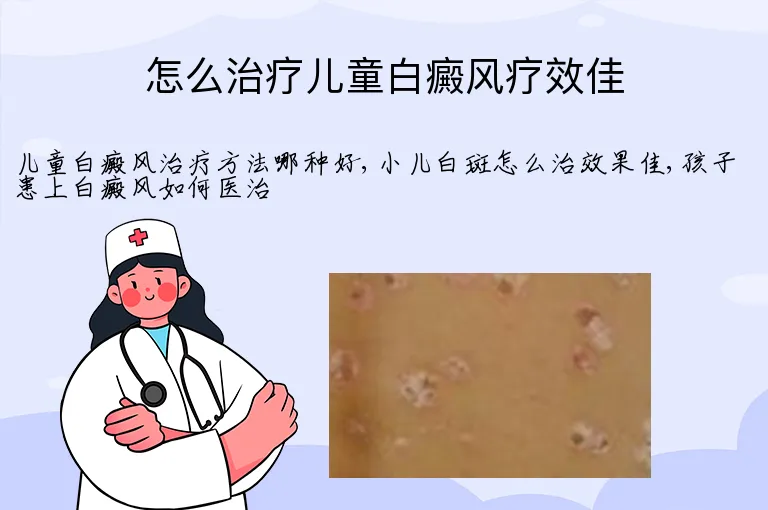 怎么治疗儿童白癜风疗效佳