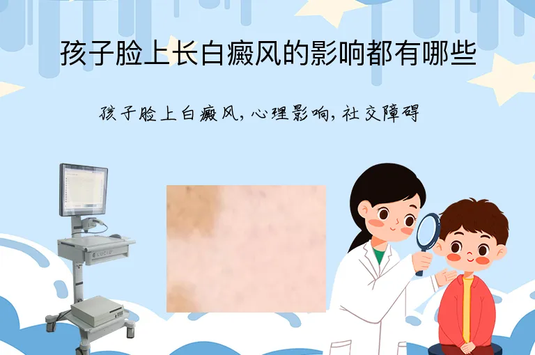 孩子脸上长白癜风的影响都有哪些