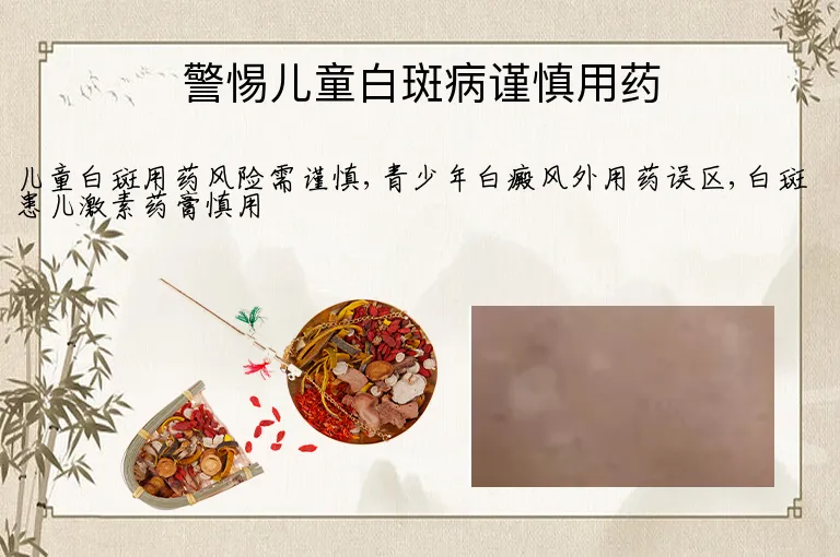 警惕儿童白斑病谨慎用药
