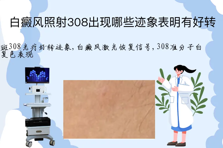 白癜风照射308出现哪些迹象表明有好转