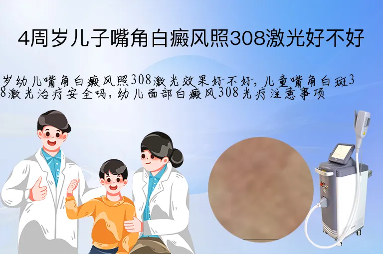 4周岁儿子嘴角白癜风照308激光好不好