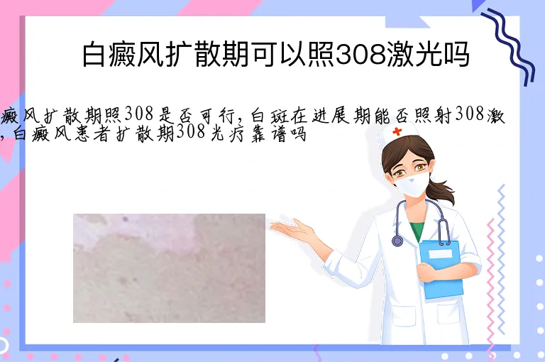 白癜风扩散期可以照308激光吗