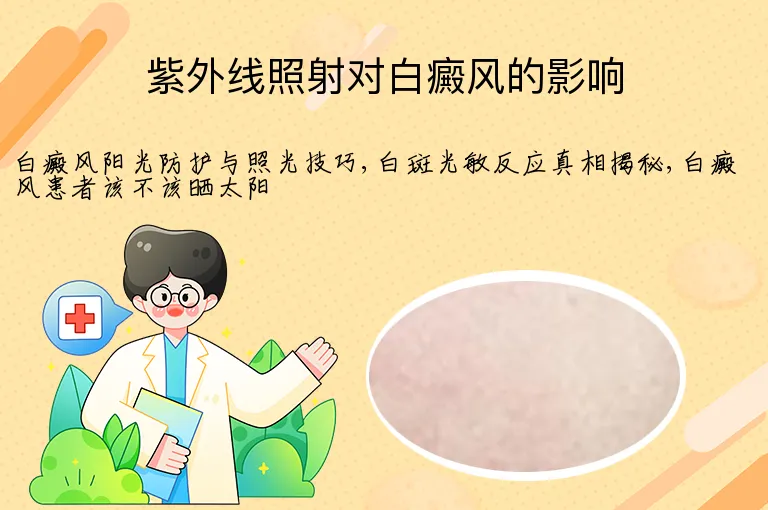 紫外线照射对白癜风的影响
