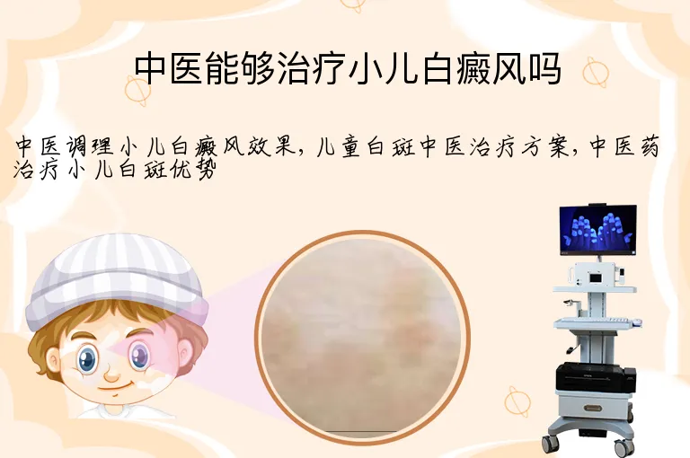 中医能够治疗小儿白癜风吗