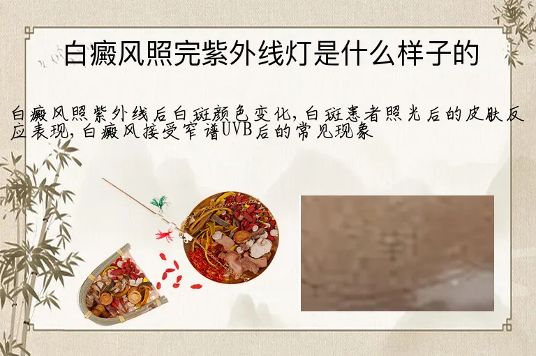 白癜风照完紫外线灯是什么样子的