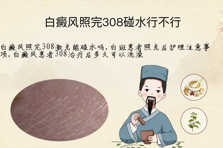 白癜风照完308碰水行不行