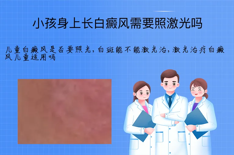 小孩身上长白癜风需要照激光吗