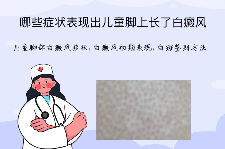 哪些症状表现出儿童脚上长了白癜风