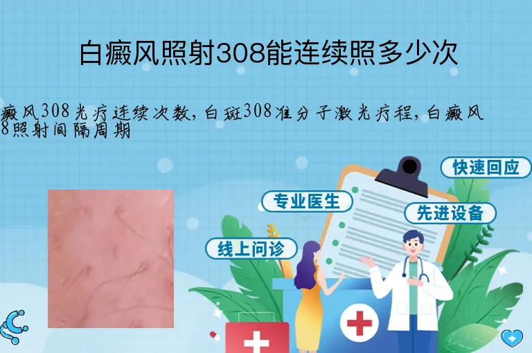 白癜风照射308能连续照多少次