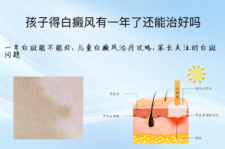 孩子得白癜风有一年了还能治好吗