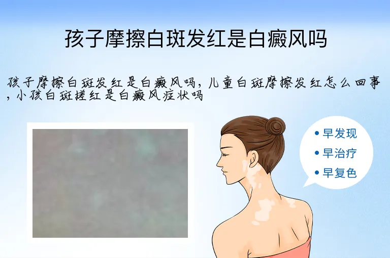 孩子摩擦白斑发红是白癜风吗