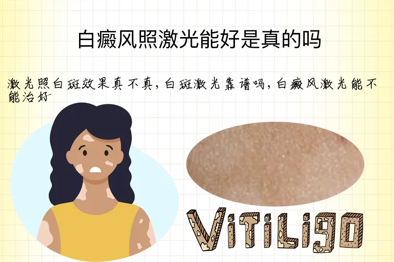 白癜风照激光能好是真的吗