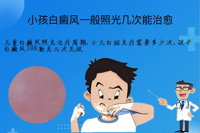 小孩白癜风一般照光几次能治愈