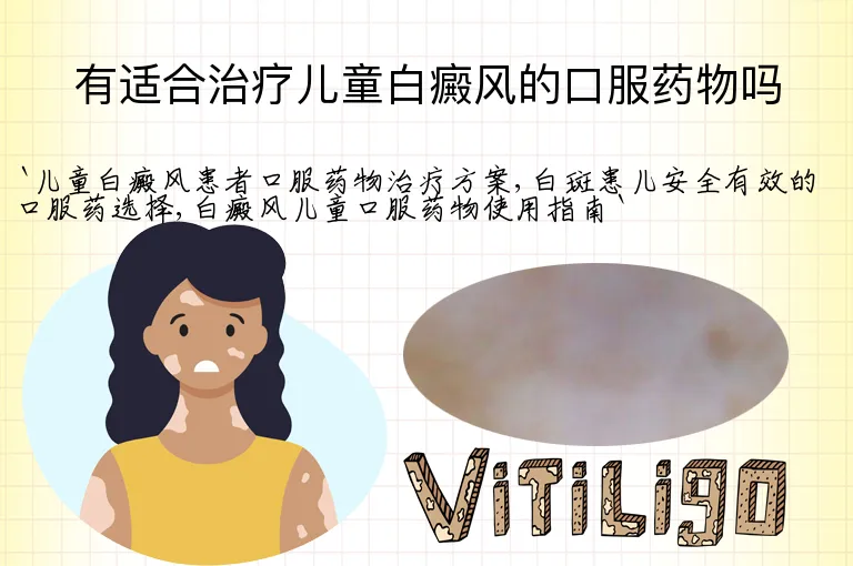 有适合治疗儿童白癜风的口服药物吗