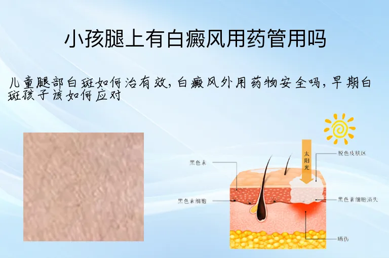 小孩腿上有白癜风用药管用吗
