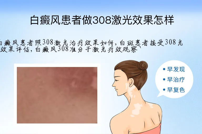 白癜风患者做308激光效果怎样