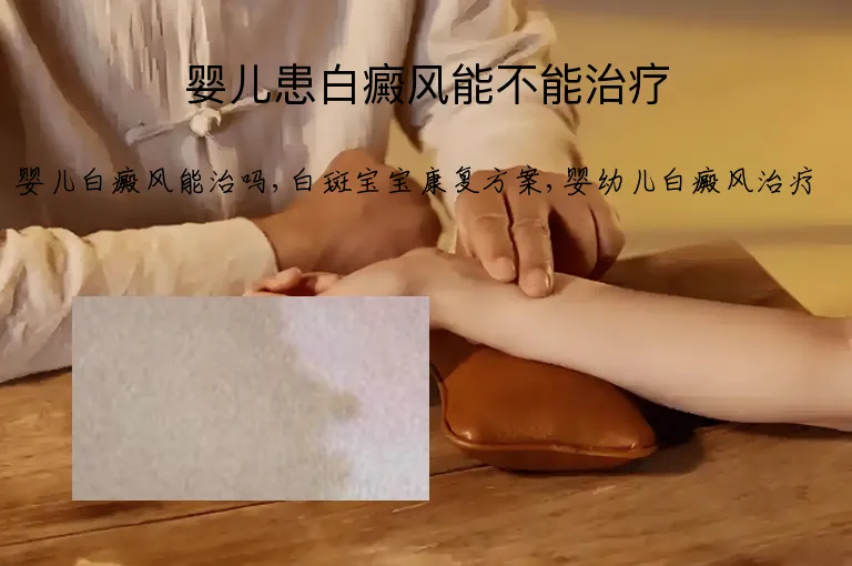 婴儿患白癜风能不能治疗