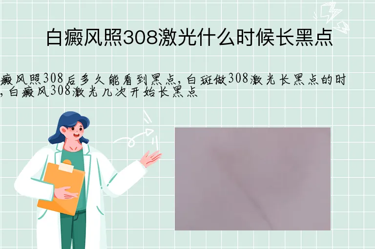 白癜风照308激光什么时候长黑点