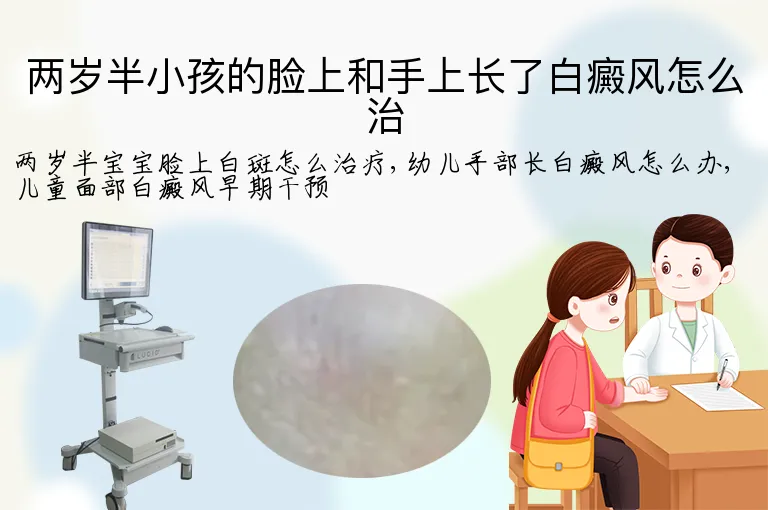 两岁半小孩的脸上和手上长了白癜风怎么治