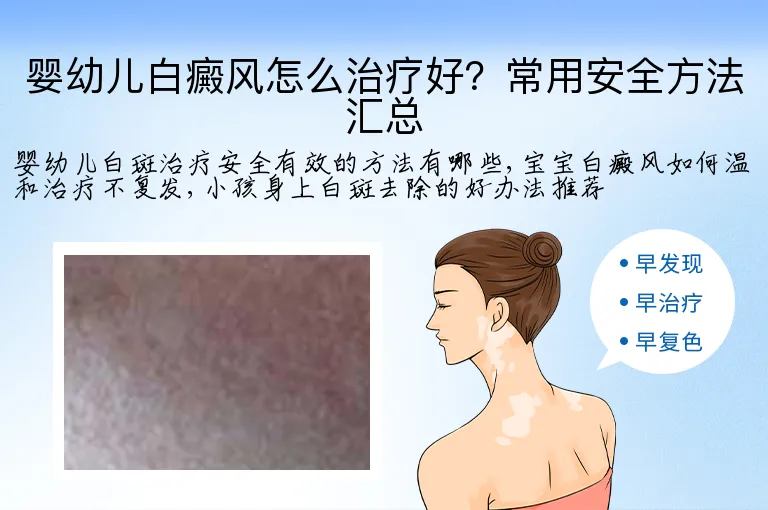 婴幼儿白癜风怎么治疗好?常用安全方法汇总